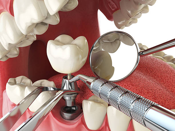 Best Emergency Root Canal Therapy in Pierce, CO